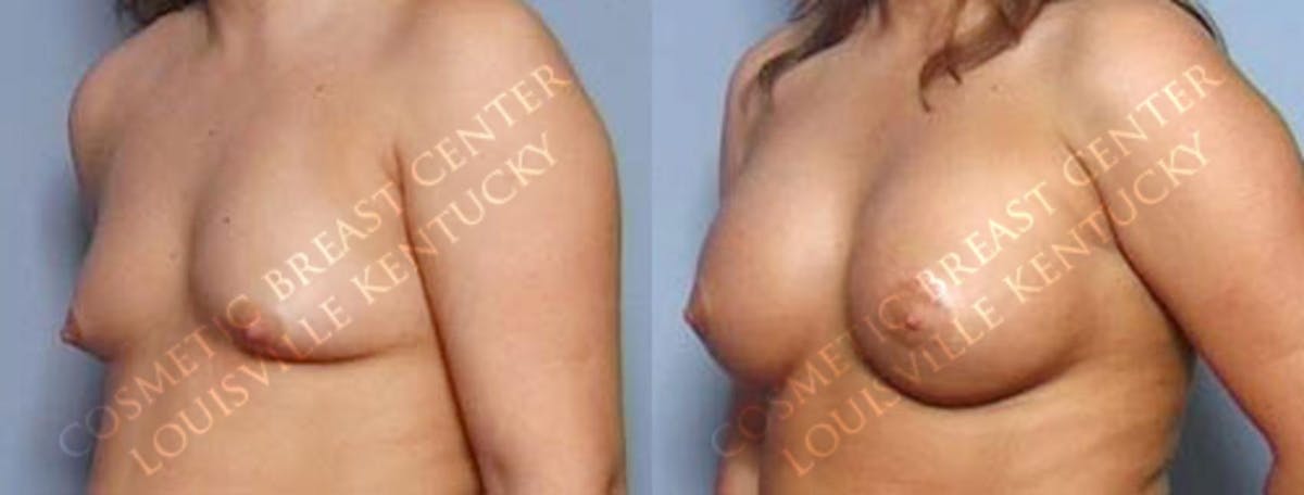 Lift Before & After Gallery - Patient 248337 - Image 2