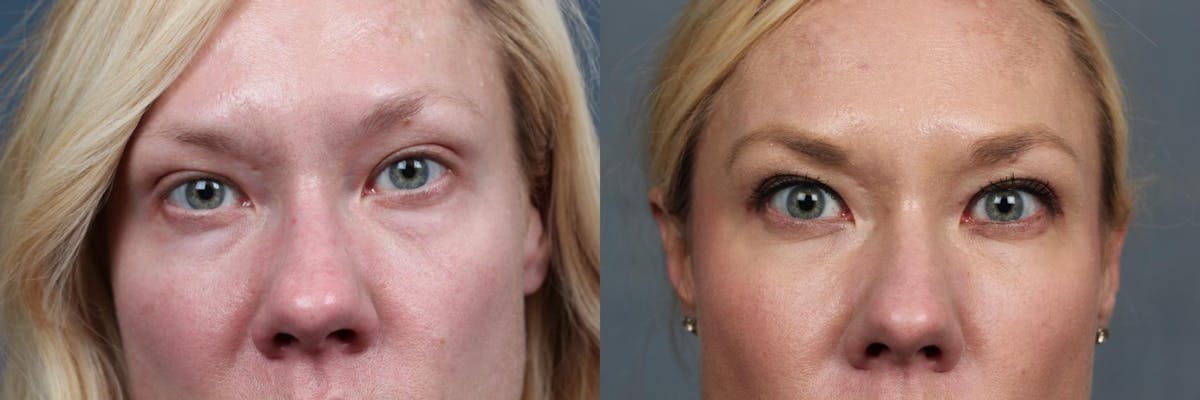 Dermal Fillers Before & After Gallery - Patient 683600 - Image 1