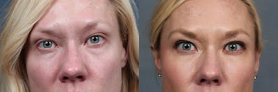 Dermal Fillers Before & After Gallery - Patient 683600 - Image 1