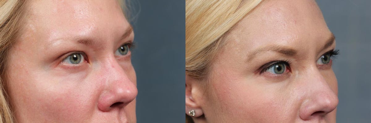 Dermal Fillers Before & After Gallery - Patient 683600 - Image 2