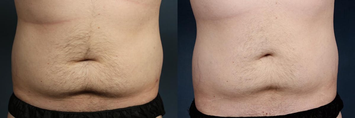 CoolSculpting Before & After Gallery - Patient 180186 - Image 1