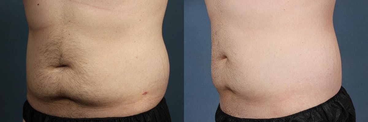 CoolSculpting Before & After Gallery - Patient 180186 - Image 2