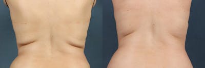 CoolSculpting Before & After Gallery - Patient 196538 - Image 1