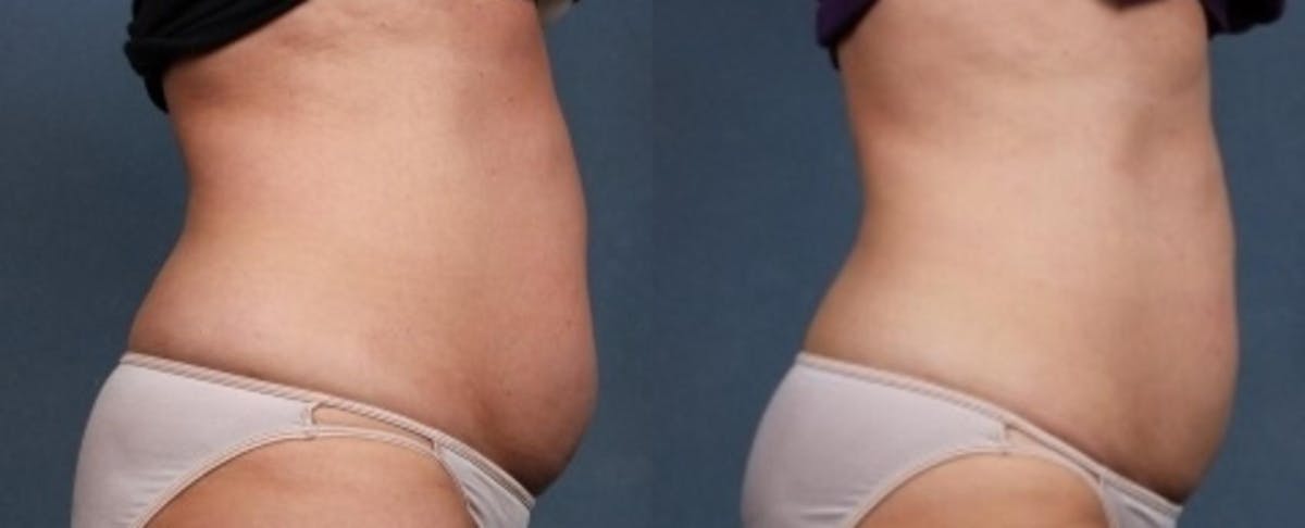 CoolSculpting Before & After Gallery - Patient 147110 - Image 1