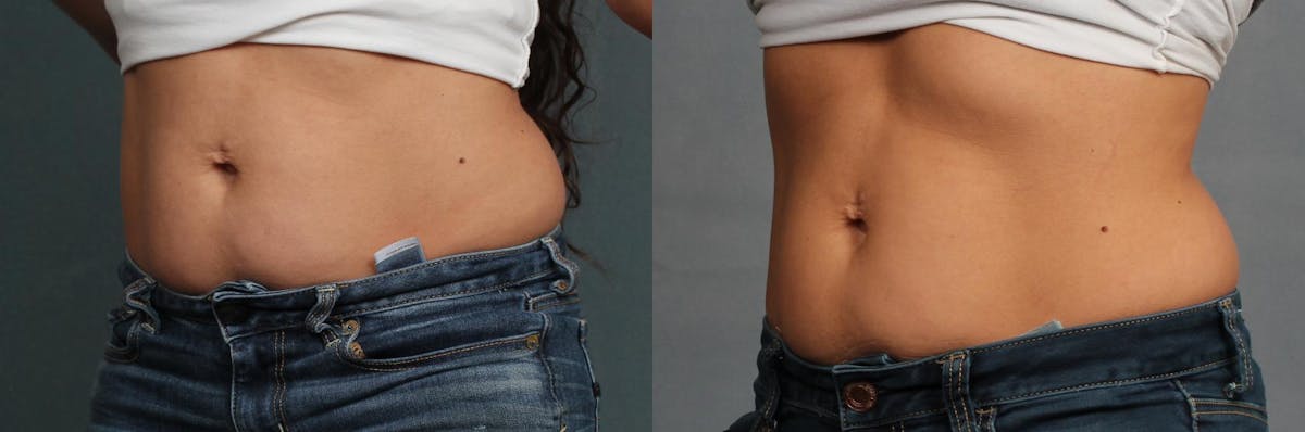 CoolSculpting Before & After Gallery - Patient 254070 - Image 2