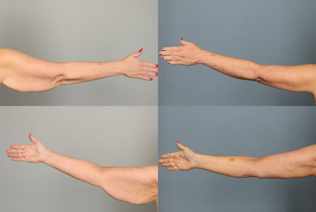 Arm Lift Before & After Gallery - Patient 661697 - Image 1