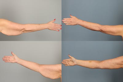 Arm Lift Before & After Gallery - Patient 661697 - Image 1
