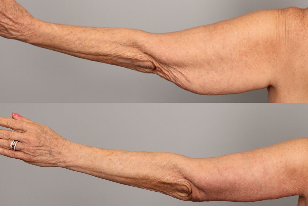 Arm Lift Before & After Gallery - Patient 808942 - Image 1