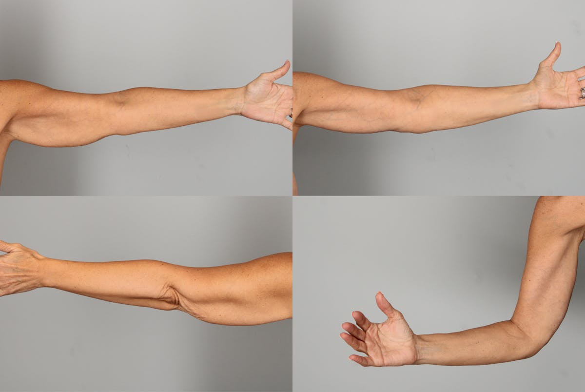 Arm Lift Before & After Gallery - Patient 257779 - Image 1