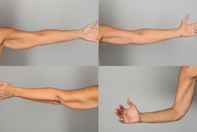 Arm Lift Before & After Gallery - Patient 257779 - Image 1