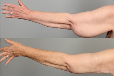 Arm Lift Before & After Gallery - Patient 305094 - Image 1