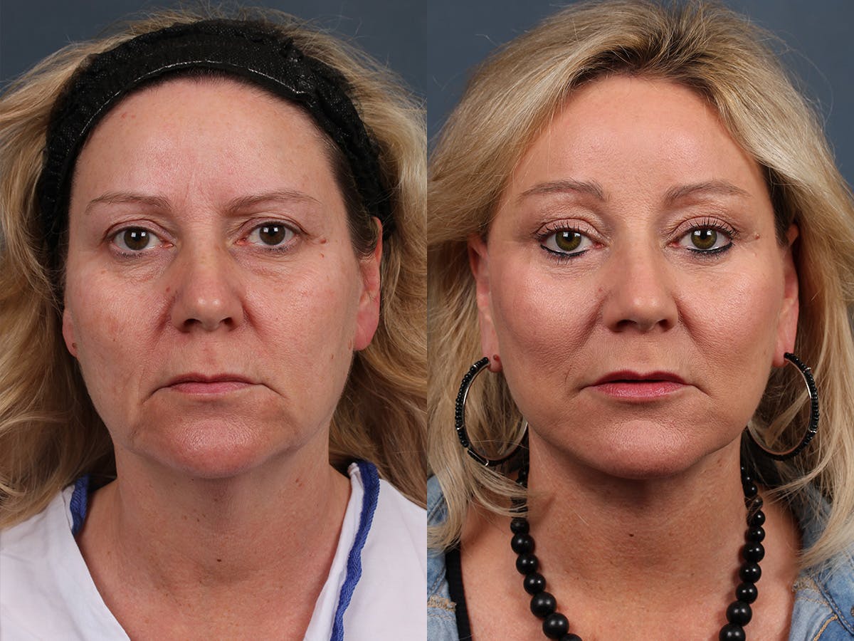 Facelift Before & After Gallery - Patient 134472 - Image 1