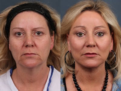 Facelift Before & After Gallery - Patient 134472 - Image 1