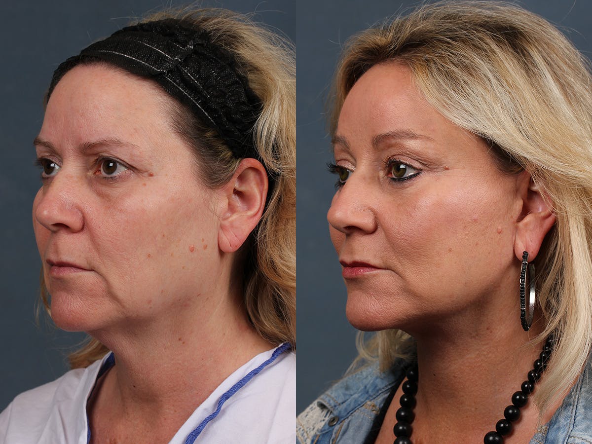 Facelift Before & After Gallery - Patient 134472 - Image 2