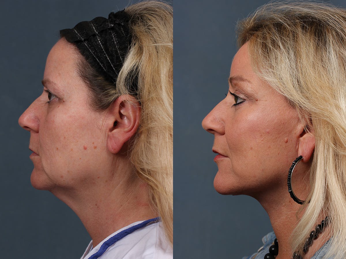 Facelift Before & After Gallery - Patient 134472 - Image 3