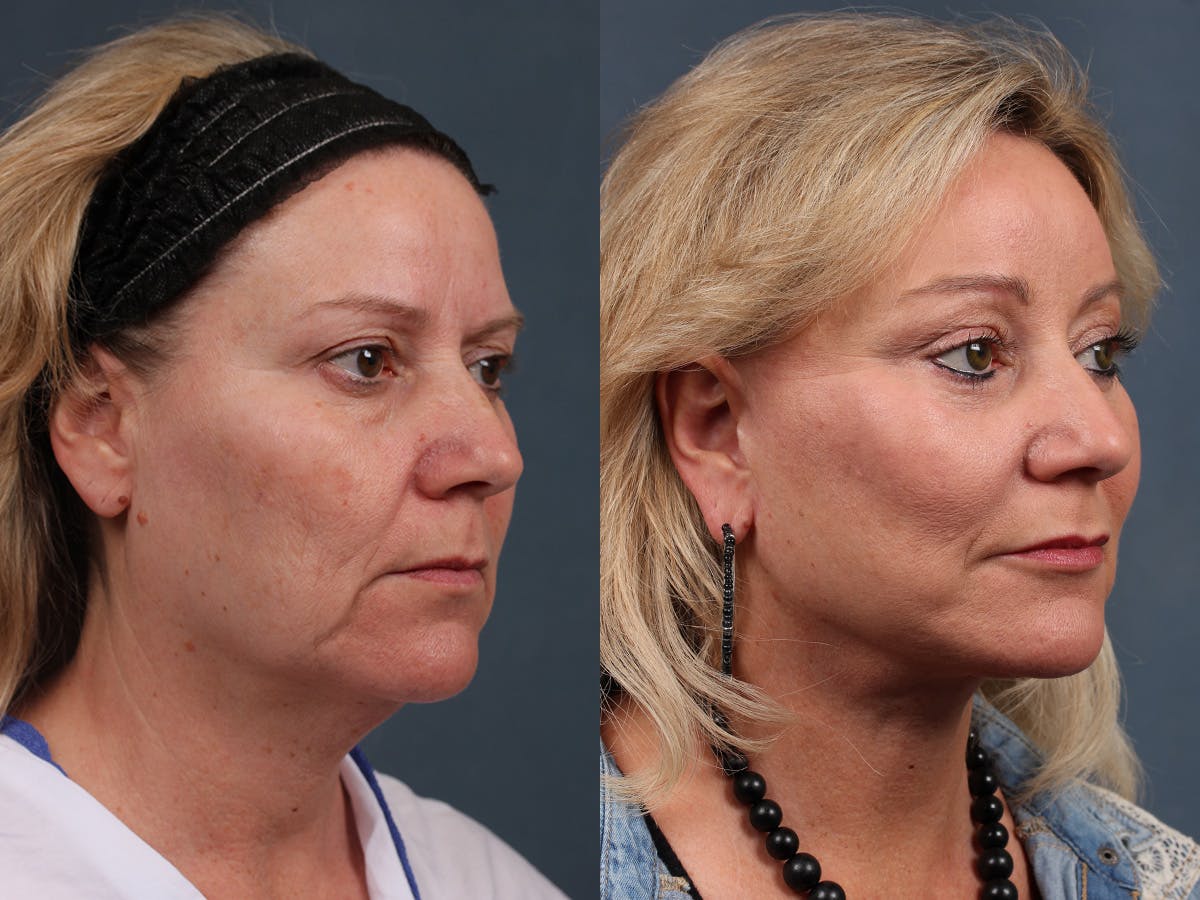 Facelift Before & After Gallery - Patient 134472 - Image 4