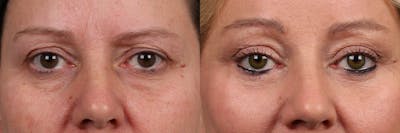 Eyelid Surgery Before & After Gallery - Patient 226858 - Image 1