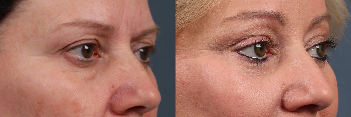 Eyelid Surgery Before & After Gallery - Patient 226858 - Image 4