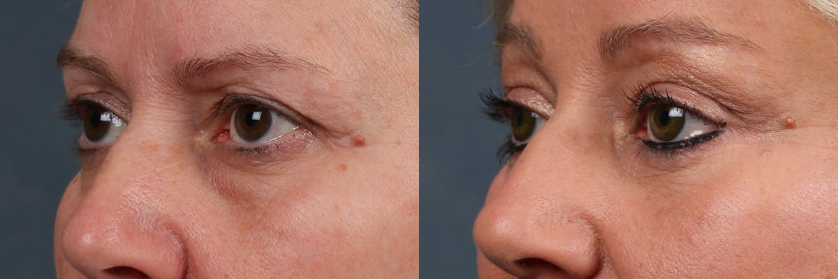 Eyelid Surgery Before & After Gallery - Patient 226858 - Image 2