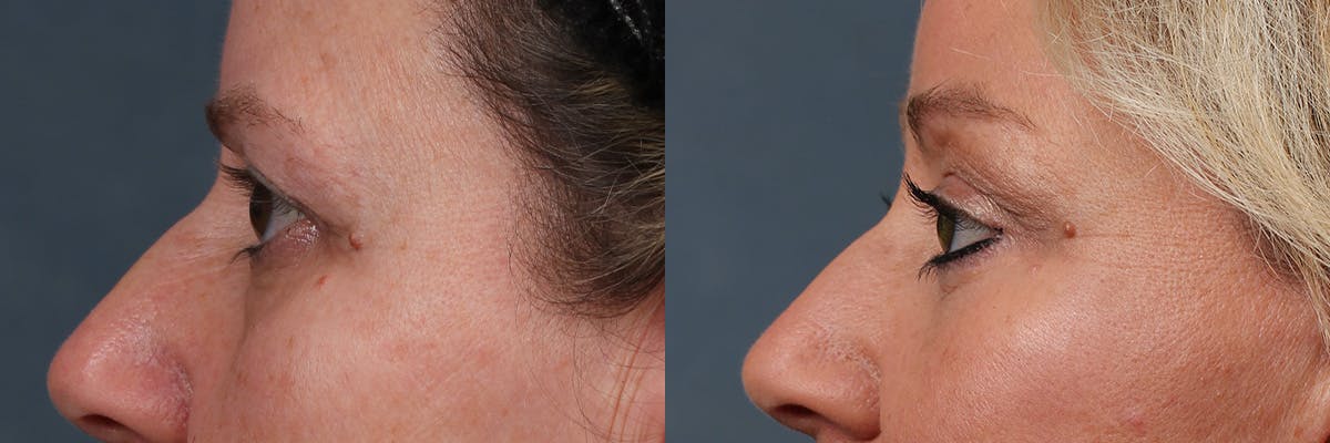 Eyelid Surgery Before & After Gallery - Patient 226858 - Image 3
