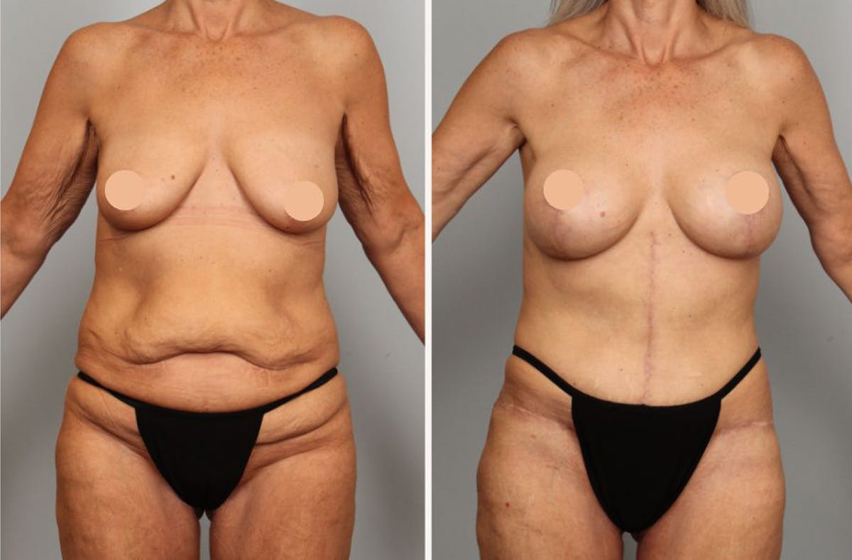 Tummy Tuck Before & After Gallery - Patient 160020 - Image 1