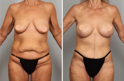 Tummy Tuck Before & After Gallery - Patient 160020 - Image 1