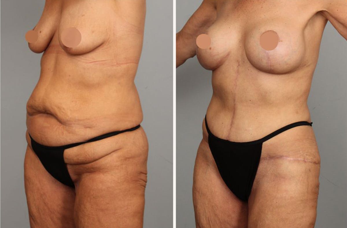 Tummy Tuck Before & After Gallery - Patient 160020 - Image 2