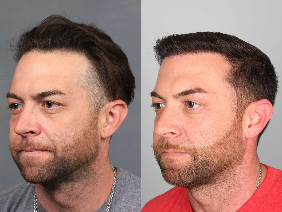 NeoGraft Before & After Gallery - Patient 380434 - Image 2