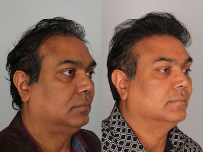 NeoGraft Before & After Gallery - Patient 333320 - Image 1