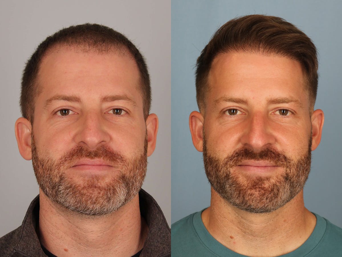 NeoGraft Before & After Gallery - Patient 869950 - Image 1