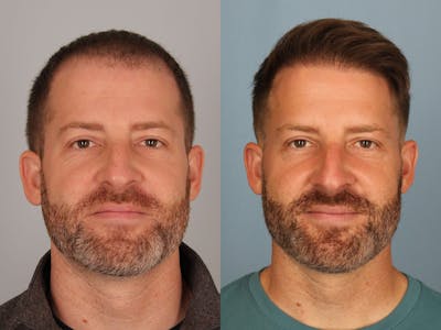 NeoGraft Before & After Gallery - Patient 869950 - Image 1