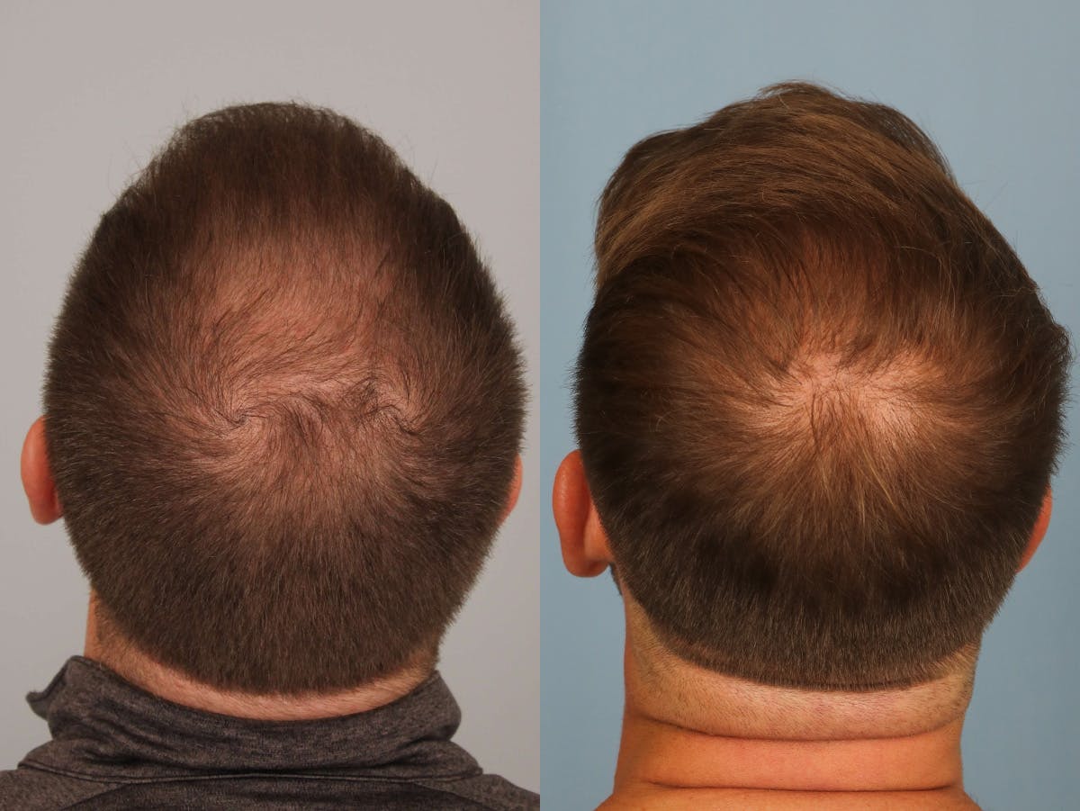 NeoGraft Before & After Gallery - Patient 869950 - Image 2