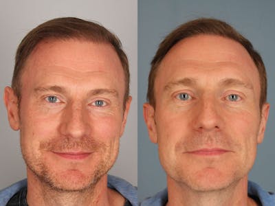 NeoGraft Before & After Gallery - Patient 391445 - Image 1