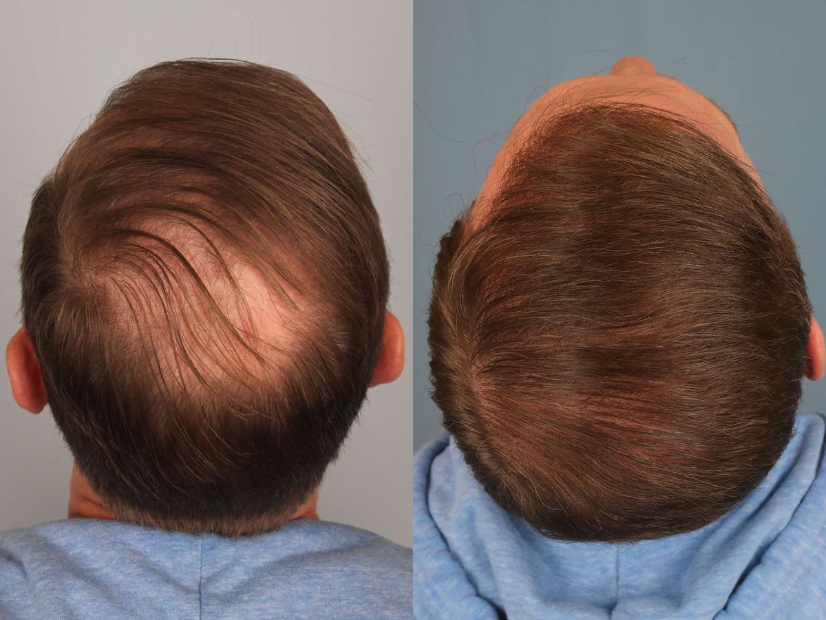NeoGraft Before & After Gallery - Patient 391445 - Image 2