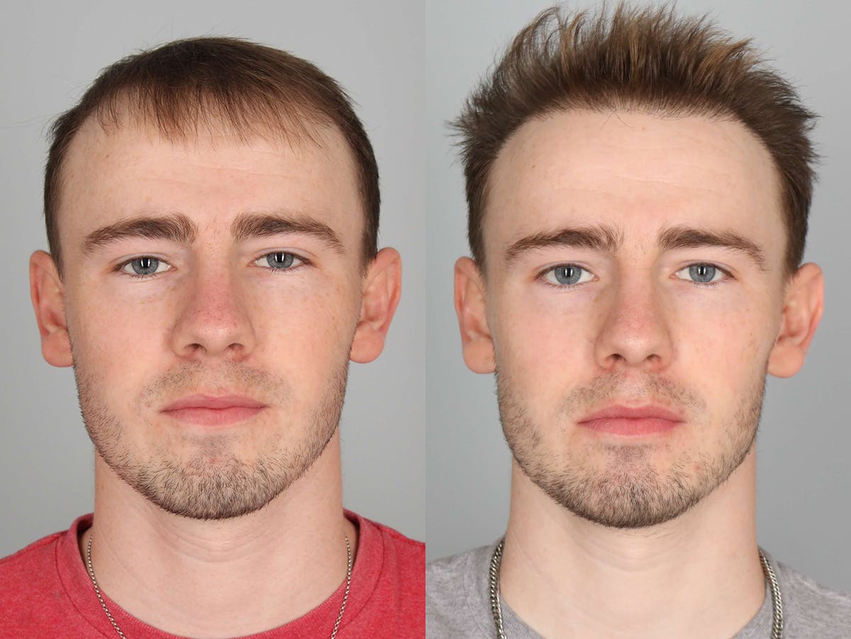 NeoGraft Before & After Gallery - Patient 150986 - Image 1