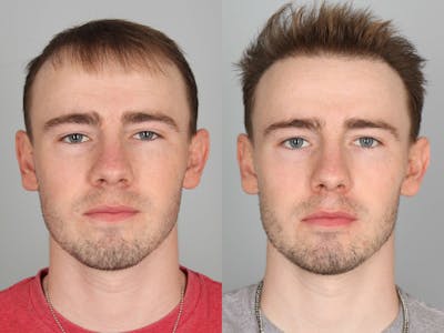 NeoGraft Before & After Gallery - Patient 150986 - Image 1