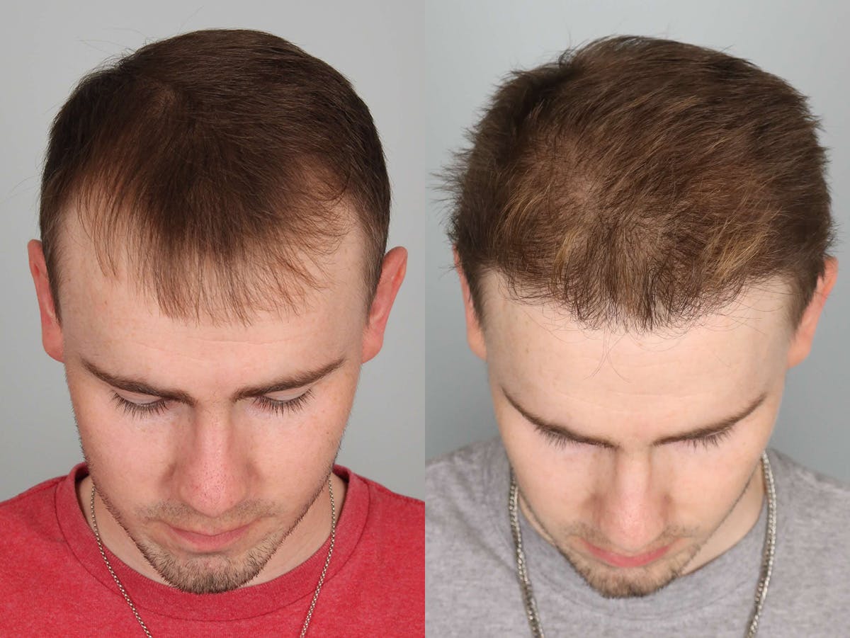 NeoGraft Before & After Gallery - Patient 150986 - Image 2