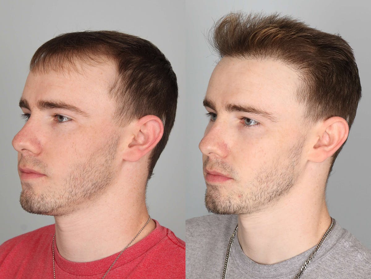 NeoGraft Before & After Gallery - Patient 150986 - Image 3