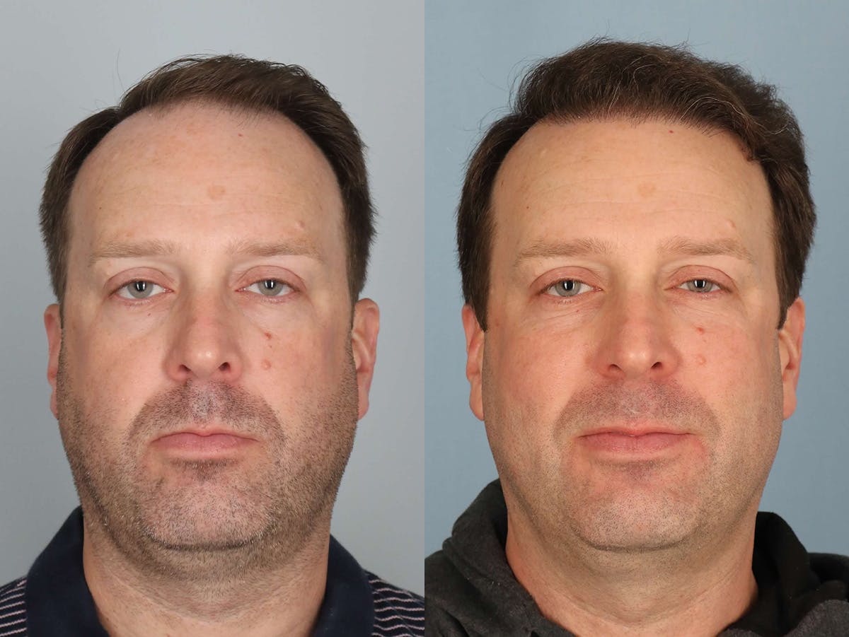 NeoGraft Before & After Gallery - Patient 213041 - Image 1