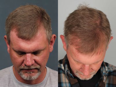NeoGraft Before & After Gallery - Patient 425814 - Image 1