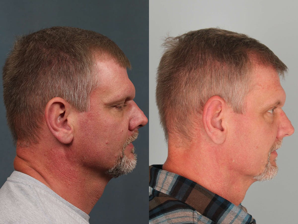 NeoGraft Before & After Gallery - Patient 425814 - Image 2