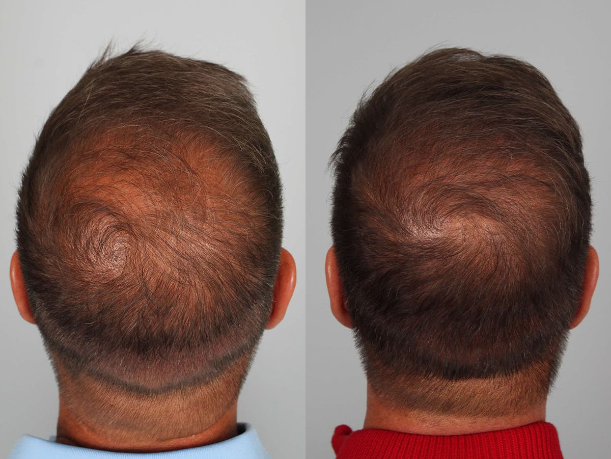 NeoGraft Before & After Gallery - Patient 384494 - Image 3