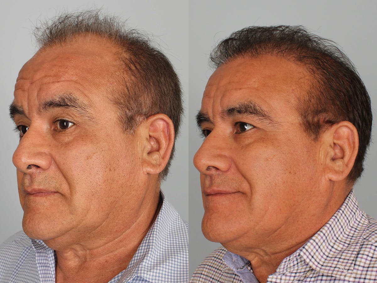 NeoGraft Before & After Gallery - Patient 345331 - Image 2