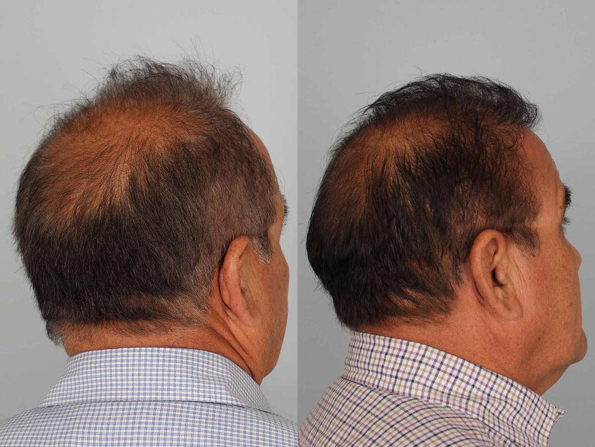 NeoGraft Before & After Gallery - Patient 345331 - Image 3