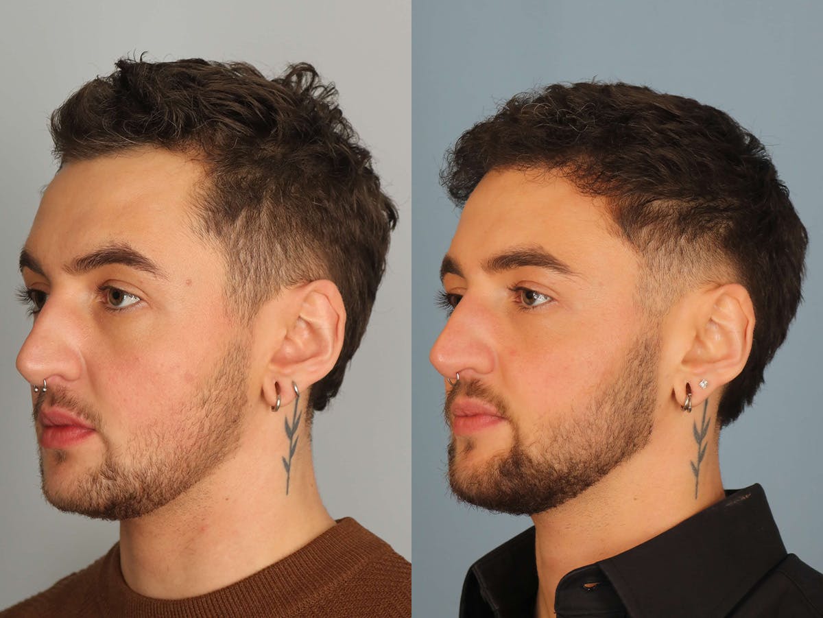 NeoGraft Before & After Gallery - Patient 236835 - Image 2