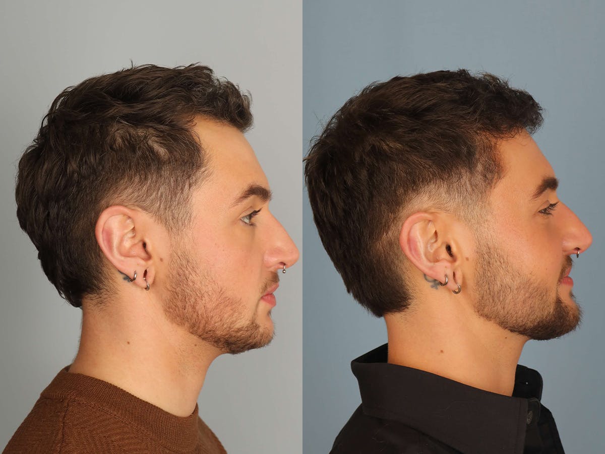 NeoGraft Before & After Gallery - Patient 236835 - Image 3