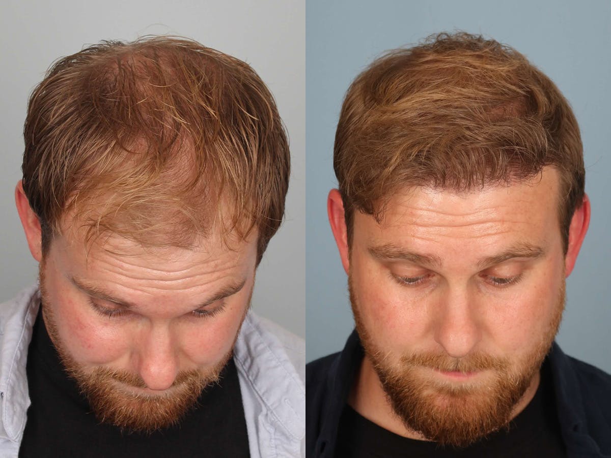NeoGraft Before & After Gallery - Patient 132383 - Image 2