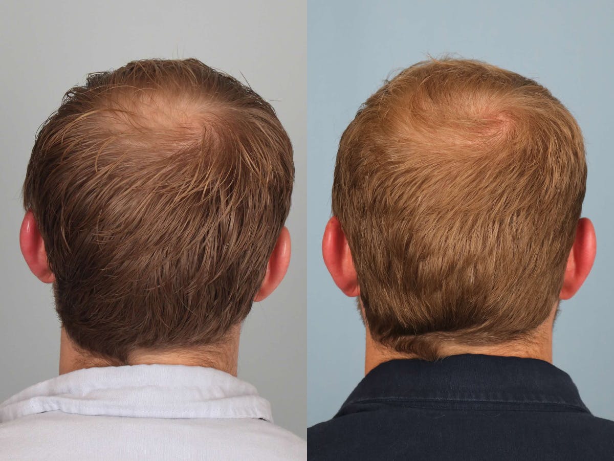 NeoGraft Before & After Gallery - Patient 132383 - Image 3