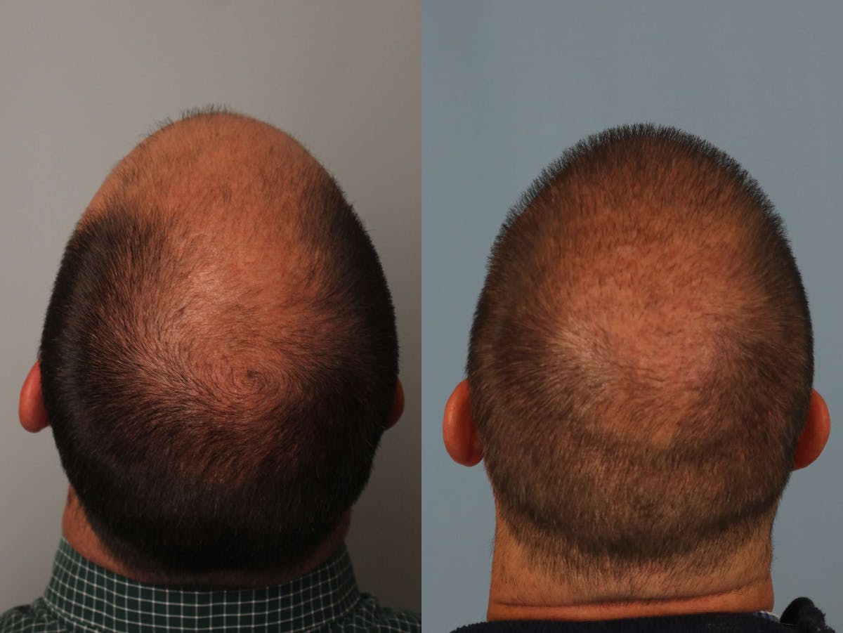 NeoGraft Before & After Gallery - Patient 344632 - Image 1