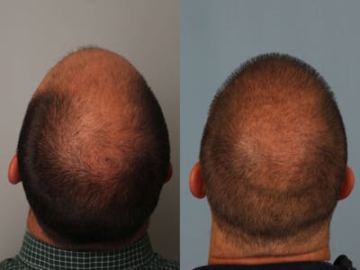 NeoGraft Before & After Gallery - Patient 344632 - Image 1